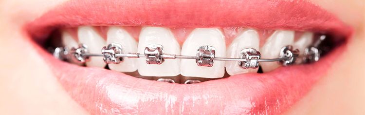 Art Clínica Dental persona con ortodoncia